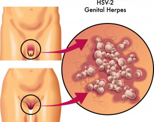 herpes symptomer